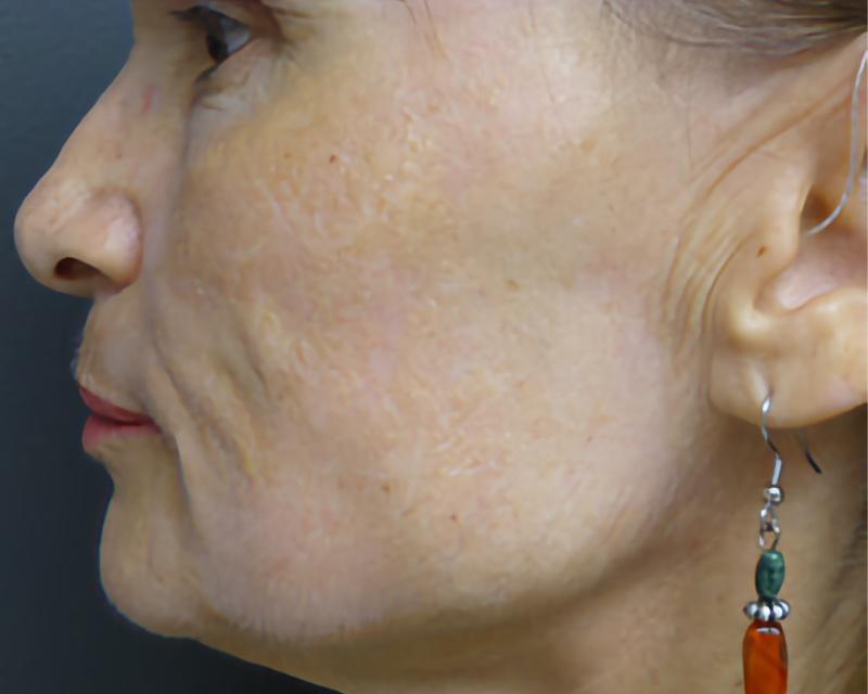 Esana Plastic Surgery Center & MedSpa chemical peel after — Guilford, CT