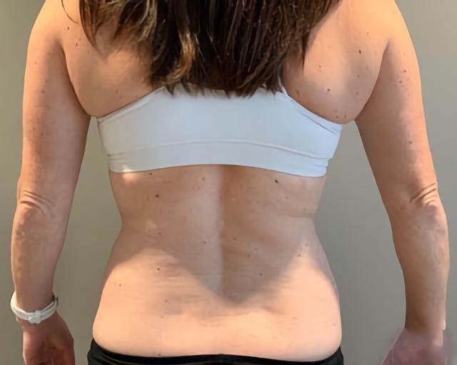 Brazilian Butt Lift before at Esana Plastic Surgery Center & MedSpa in Guilford, CT