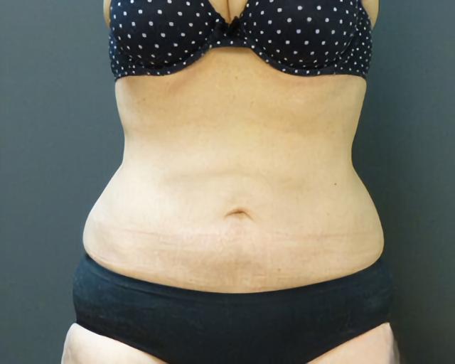 Thigh Lift after at Esana Plastic Surgery Center & MedSpa in Guilford, CT