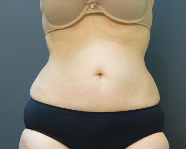 Thigh Lift before at Esana Plastic Surgery Center & MedSpa in Guilford, CT