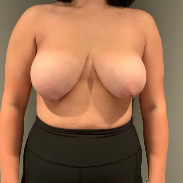 Breast Reduction before at Esana Plastic Surgery Center & MedSpa in Guilford, CT