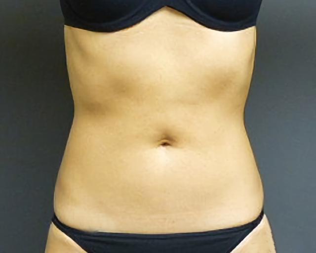 Thigh Lift after at Esana Plastic Surgery Center & MedSpa in Guilford, CT