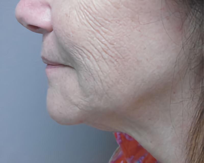 Esana Plastic Surgery Center & MedSpa facelift after — Guilford, CT