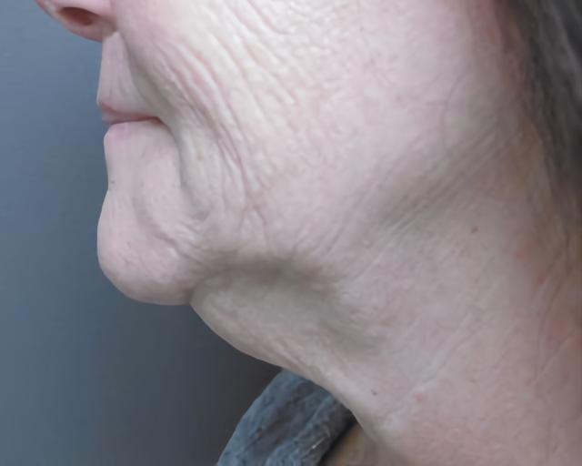 Facelift before at Esana Plastic Surgery Center & MedSpa in Guilford, CT