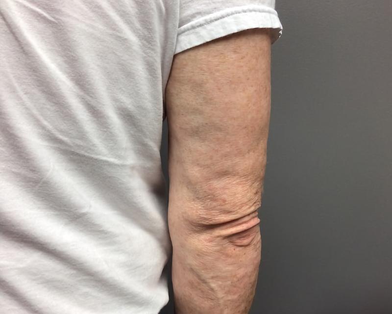 Esana Plastic Surgery Center & MedSpa skin tightening after — Guilford, CT