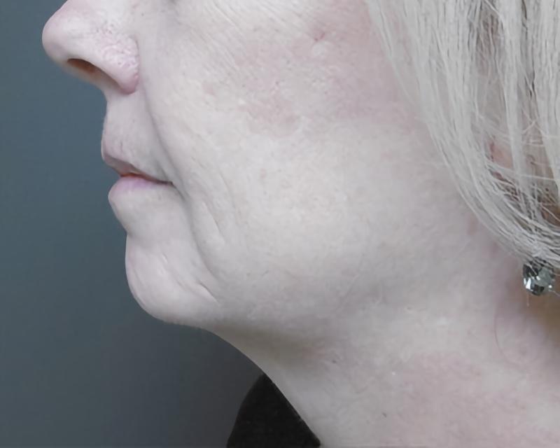 Esana Plastic Surgery Center & MedSpa facelift after — Guilford, CT