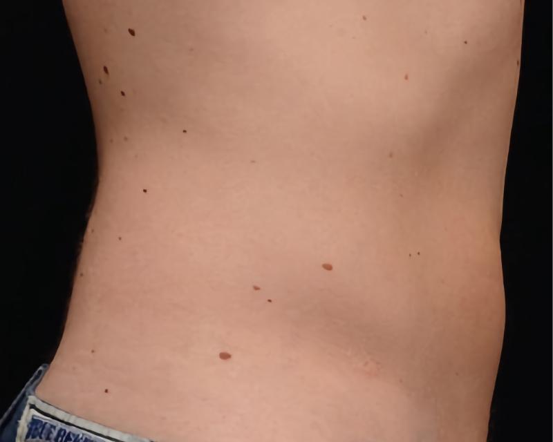 Esana Plastic Surgery Center & MedSpa coolsculpting after — Guilford, CT