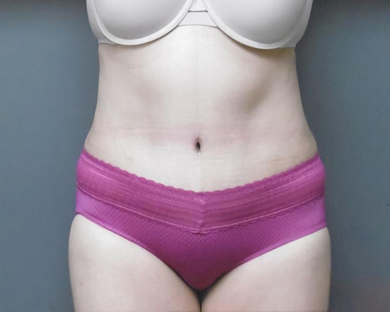 Esana Plastic Surgery Center & MedSpa tummy tuck after — Guilford, CT