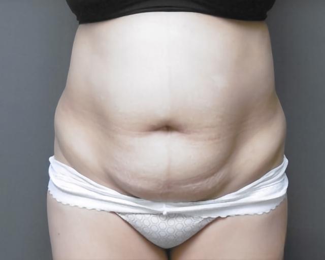 Tummy Tuck before at Esana Plastic Surgery Center & MedSpa in Guilford, CT