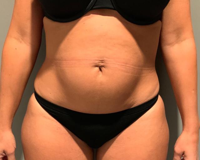 Tummy Tuck before at Esana Plastic Surgery Center & MedSpa in Guilford, CT