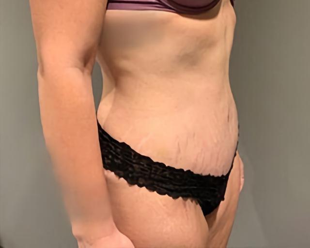 Tummy Tuck after at Esana Plastic Surgery Center & MedSpa in Guilford, CT