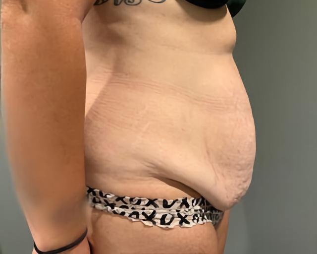 Tummy Tuck before at Esana Plastic Surgery Center & MedSpa in Guilford, CT