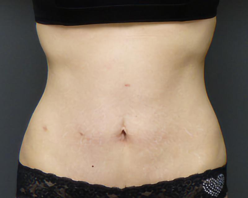 Esana Plastic Surgery Center & MedSpa tummy tuck after — Guilford, CT