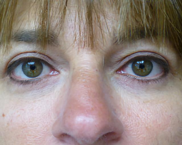 Blepharoplasty after at Esana Plastic Surgery Center & MedSpa in Guilford, CT