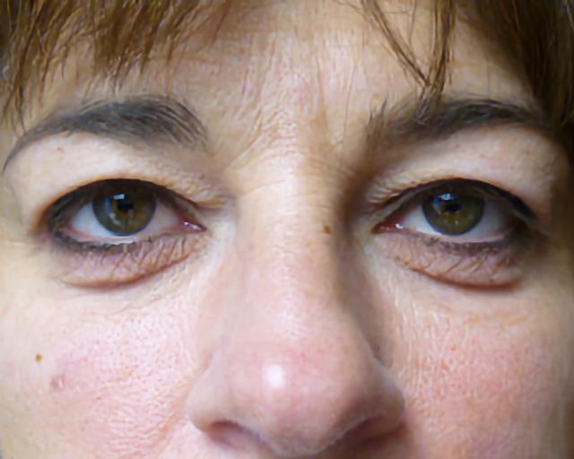 Blepharoplasty before at Esana Plastic Surgery Center & MedSpa in Guilford, CT