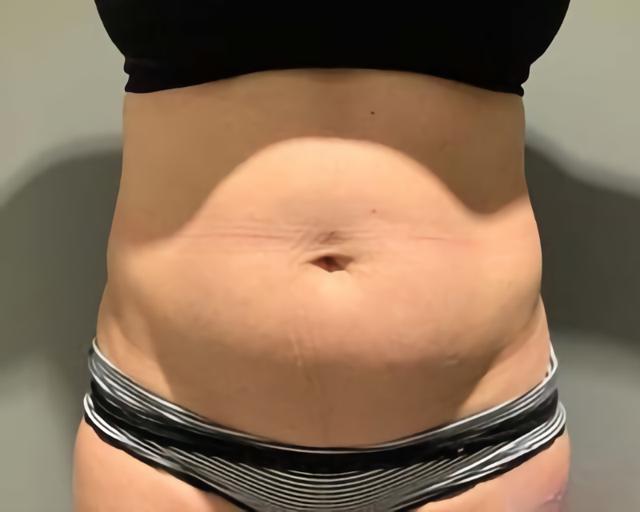 Tummy Tuck before at Esana Plastic Surgery Center & MedSpa in Guilford, CT
