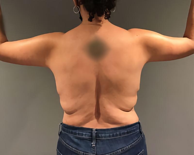 Esana Plastic Surgery Center & MedSpa arm lift after — Guilford, CT