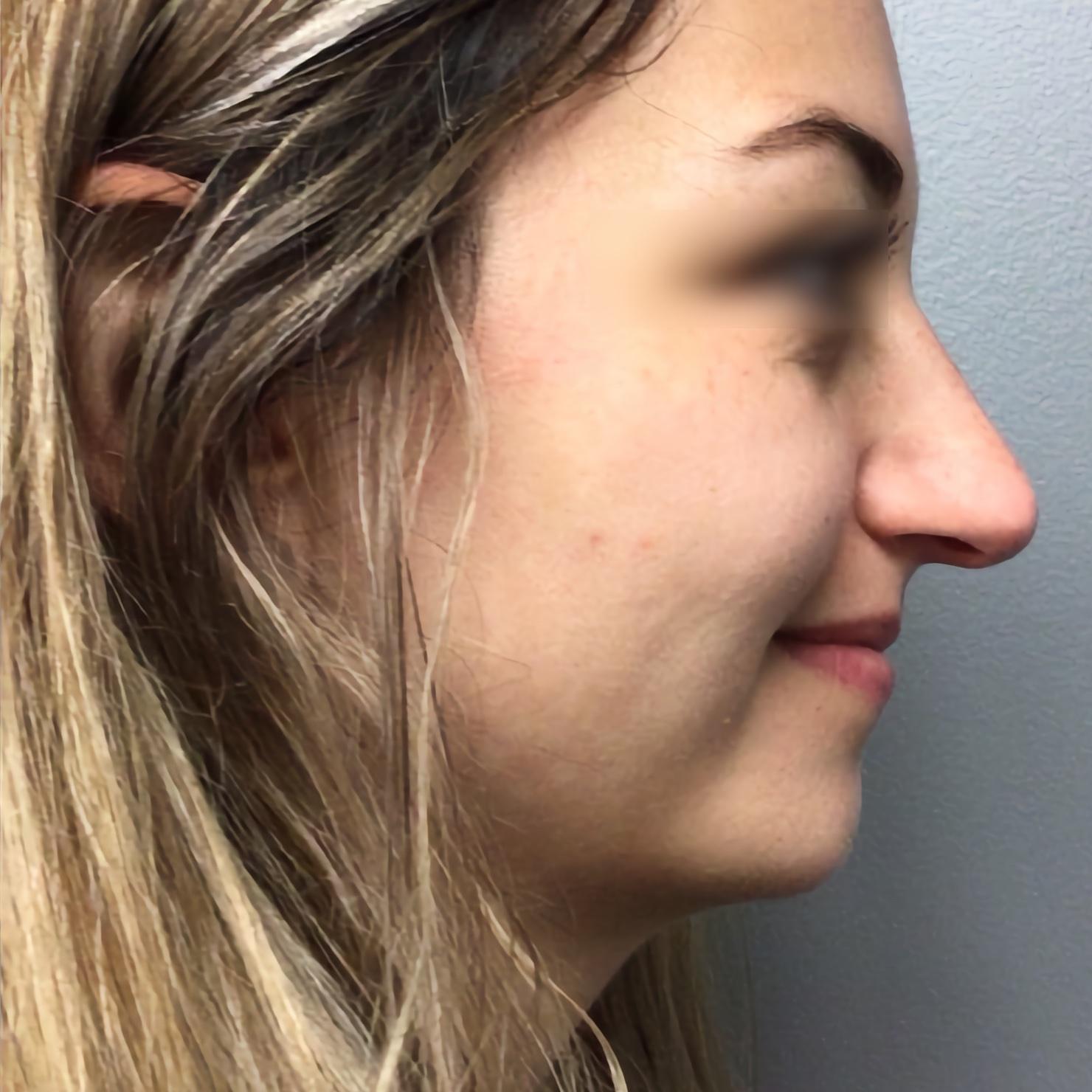 Esana Plastic Surgery Center & MedSpa rhinoplasty after — Guilford, CT