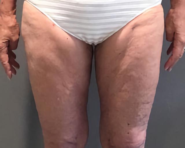 Thigh Lift after at Esana Plastic Surgery Center & MedSpa in Guilford, CT