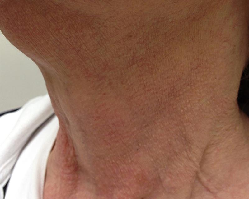Esana Plastic Surgery Center & MedSpa skin tightening after — Guilford, CT