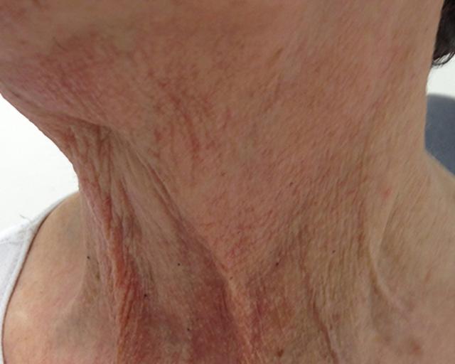 Morpheus8 before at Esana Plastic Surgery Center & MedSpa in Guilford, CT