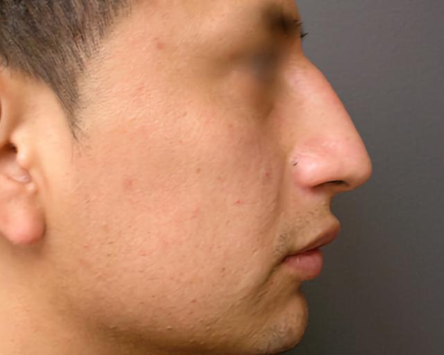 Liquid Rhinoplasty after at Esana Plastic Surgery Center & MedSpa in Guilford, CT