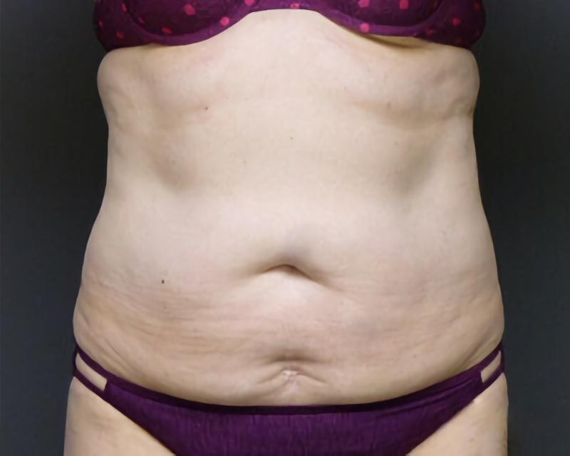 Esana Plastic Surgery Center & MedSpa coolsculpting after — Guilford, CT