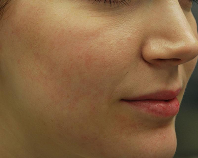 Esana Plastic Surgery Center & MedSpa skin tightening after — Guilford, CT