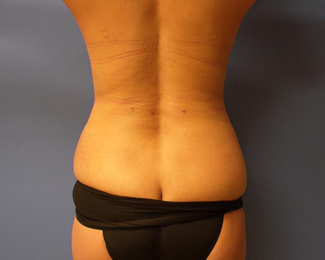 Brazilian Butt Lift after at Esana Plastic Surgery Center & MedSpa in Guilford, CT