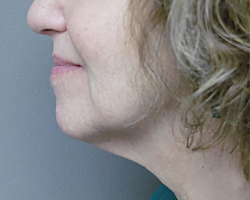 Esana Plastic Surgery Center & MedSpa facelift after — Guilford, CT