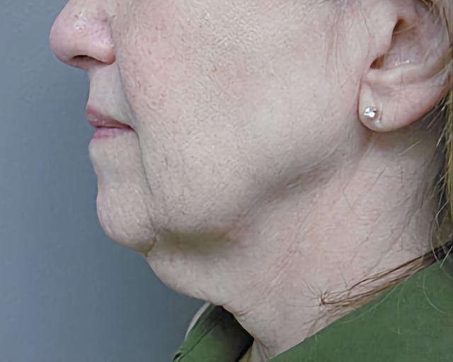 Facelift before at Esana Plastic Surgery Center & MedSpa in Guilford, CT