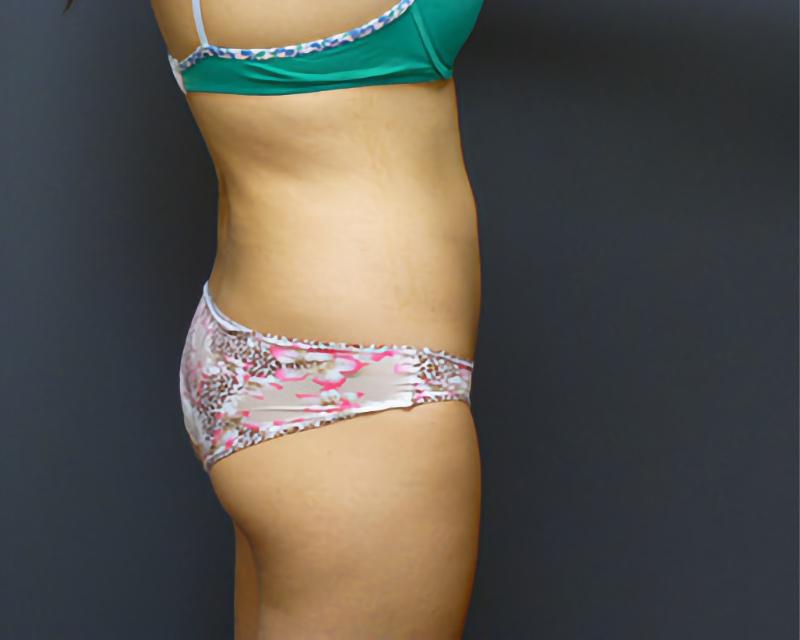 Esana Plastic Surgery Center & MedSpa liposuction after — Guilford, CT