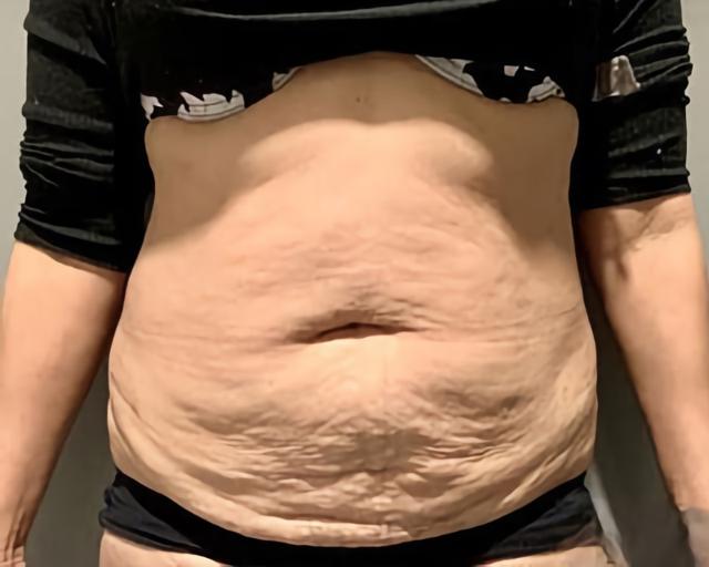 Tummy Tuck before at Esana Plastic Surgery Center & MedSpa in Guilford, CT