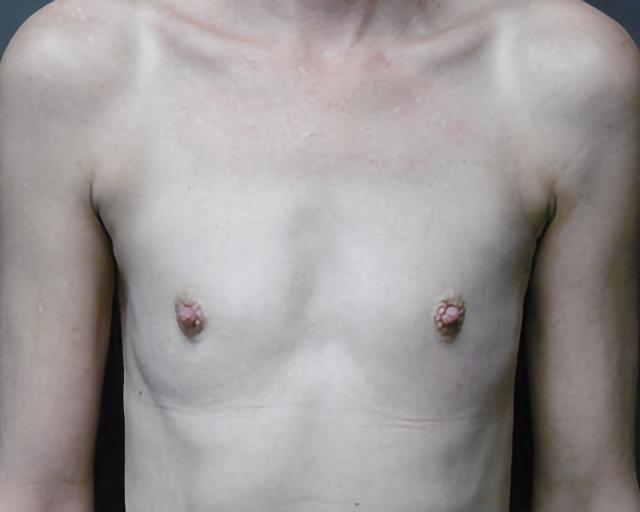 Fat Transfer Breast Augmentation before at Esana Plastic Surgery Center & MedSpa in Guilford, CT