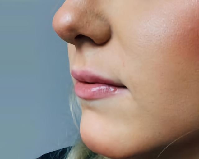 Juvederm after at Esana Plastic Surgery Center & MedSpa in Guilford, CT