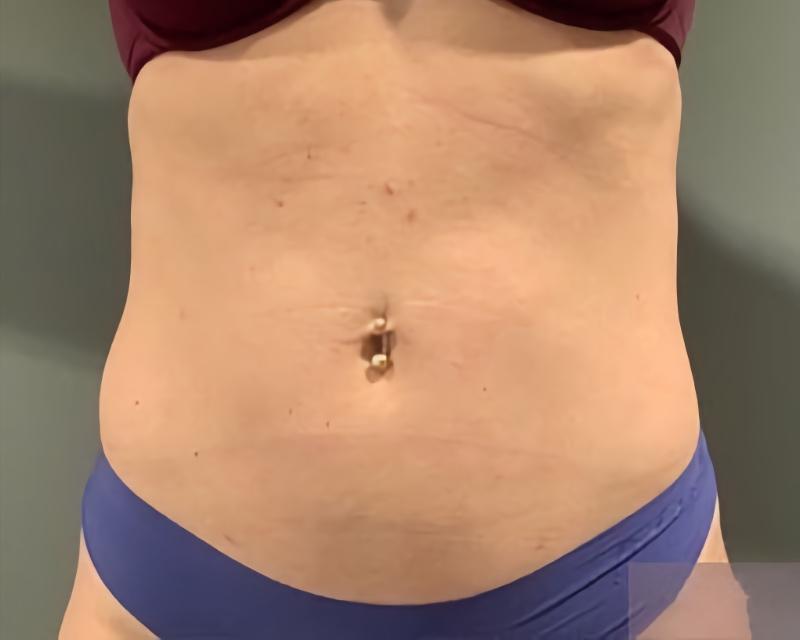 Esana Plastic Surgery Center & MedSpa liposuction after — Guilford, CT