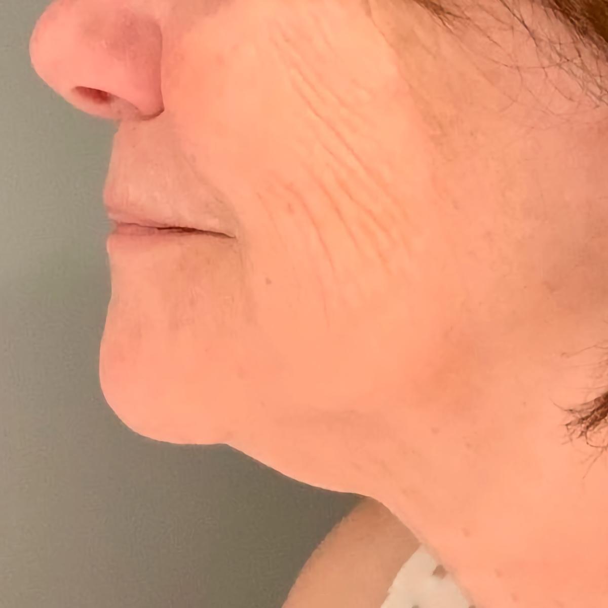 Esana Plastic Surgery Center & MedSpa skin tightening after — Guilford, CT
