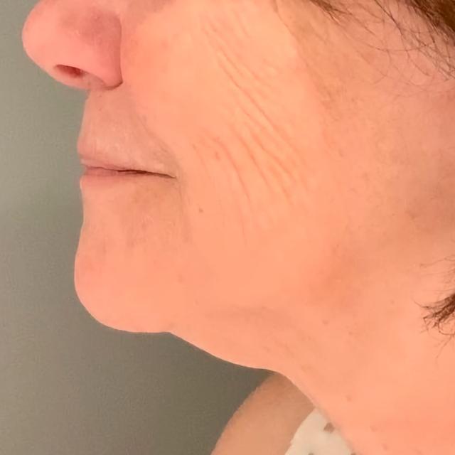 Morpheus8 after at Esana Plastic Surgery Center & MedSpa in Guilford, CT