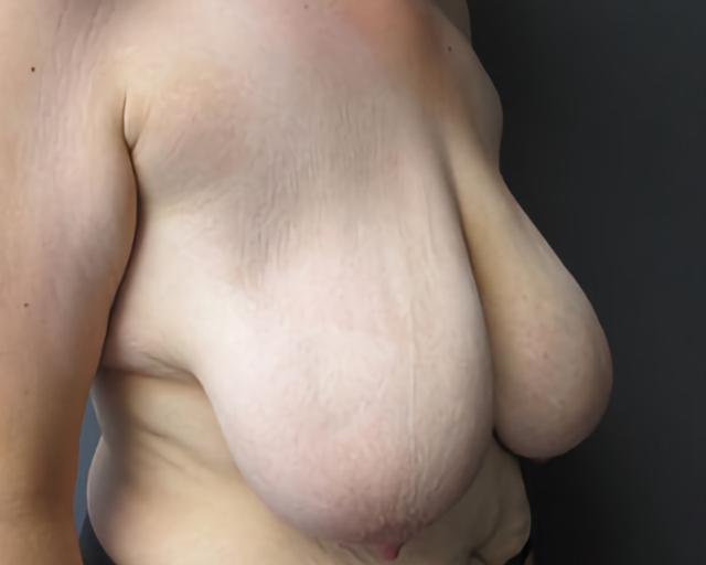 Breast Lift before at Esana Plastic Surgery Center & MedSpa in Guilford, CT