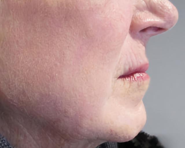 Morpheus8 after at Esana Plastic Surgery Center & MedSpa in Guilford, CT