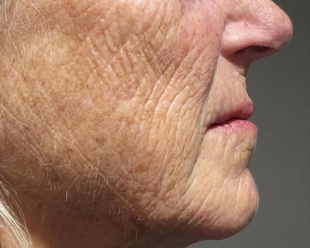 Morpheus8 before at Esana Plastic Surgery Center & MedSpa in Guilford, CT