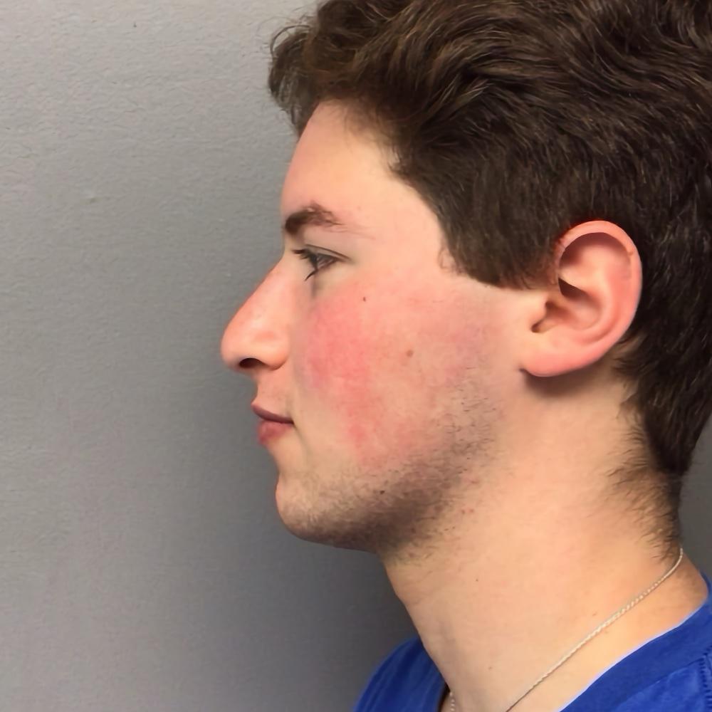Esana Plastic Surgery Center & MedSpa rhinoplasty after — Guilford, CT