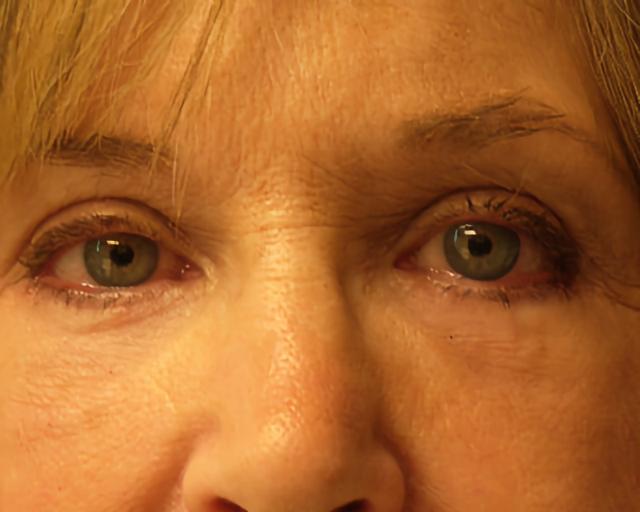 Blepharoplasty after at Esana Plastic Surgery Center & MedSpa in Guilford, CT