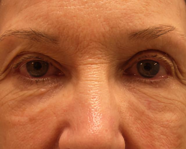 Blepharoplasty before at Esana Plastic Surgery Center & MedSpa in Guilford, CT
