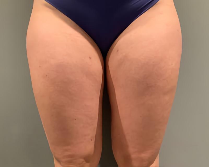 Esana Plastic Surgery Center & MedSpa liposuction after — Guilford, CT
