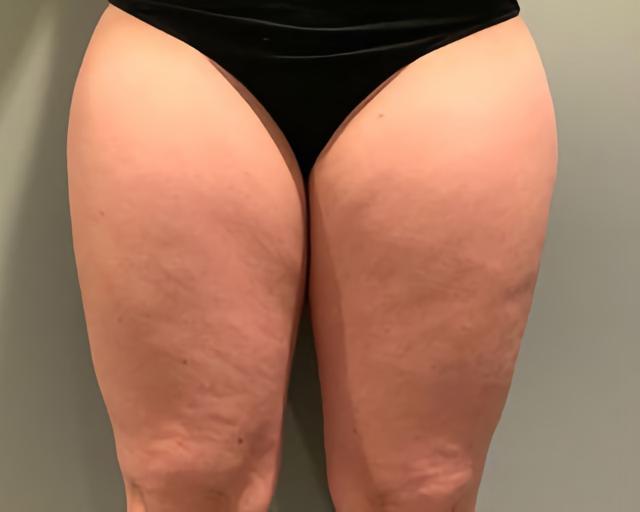 Brazilian Butt Lift before at Esana Plastic Surgery Center & MedSpa in Guilford, CT
