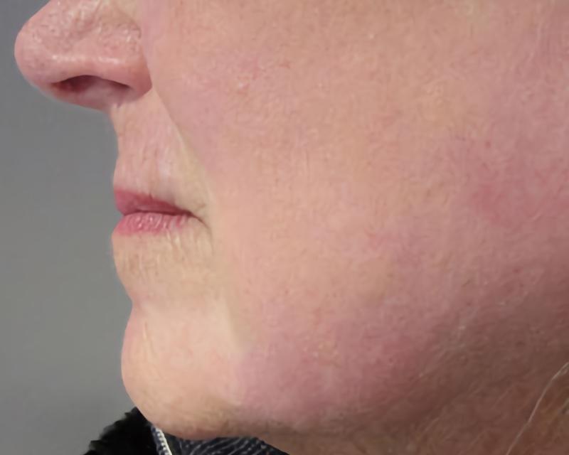 Esana Plastic Surgery Center & MedSpa chemical peel after — Guilford, CT