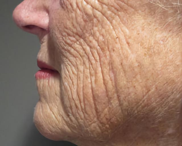 Morpheus8 before at Esana Plastic Surgery Center & MedSpa in Guilford, CT
