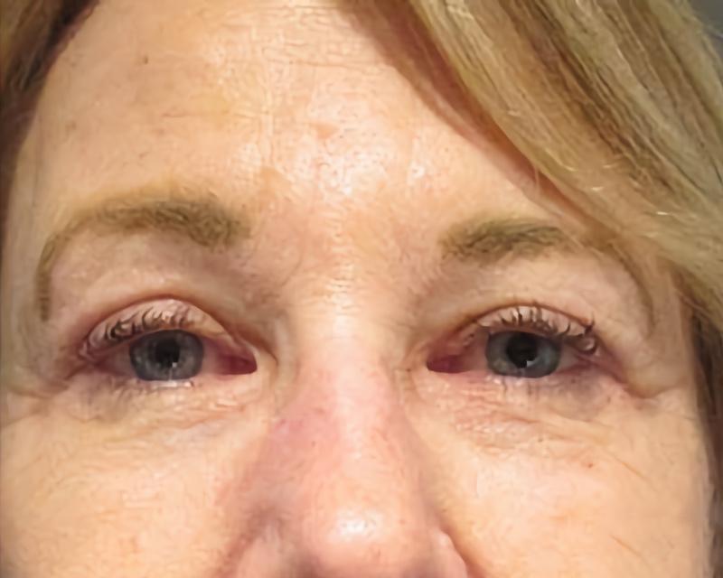 Esana Plastic Surgery Center & MedSpa blepharoplasty after — Guilford, CT