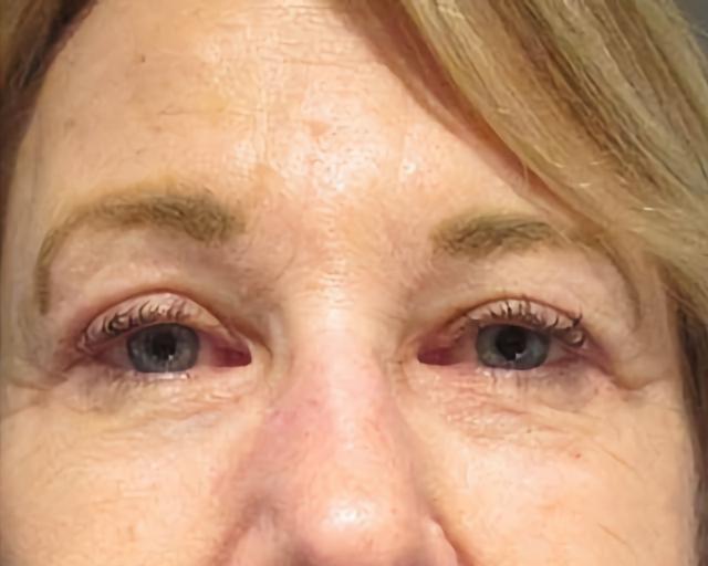 Blepharoplasty after at Esana Plastic Surgery Center & MedSpa in Guilford, CT